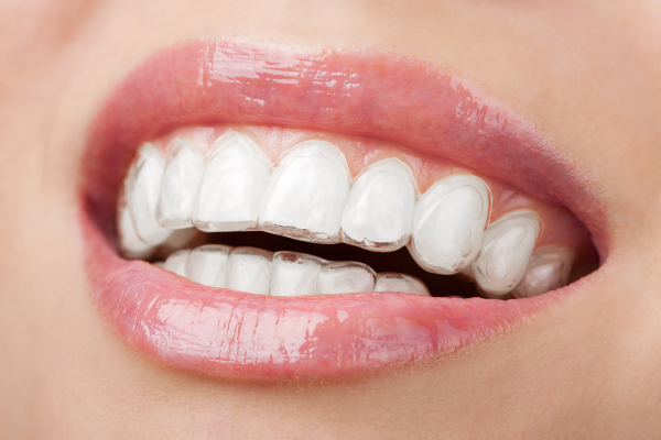 Concept per terapia ortodontica: primo piano di dentatura femminile che indossa Invisalign - Dott.ssa Chiara Piccioni